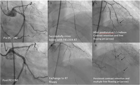 TCTAP C 098 A Gush Of Anxiety Coronary Perforation Or Coronary Cameral