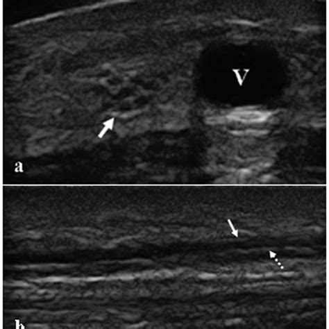 Transverse And Longitudinal Sonograms Of The Sn A Transverse Sonogram Download Scientific