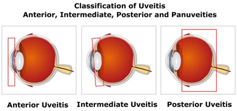 Anterior Uveitis