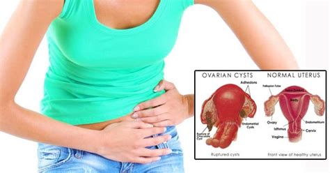 Early Warning Signs Of Ovarian Cyst Perhaps You Have It And You Do