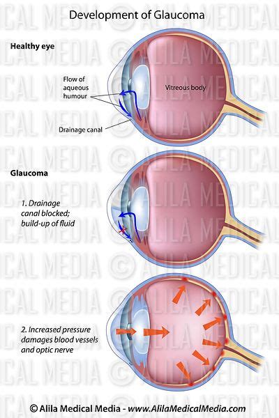 Alila Medical Media Glaucoma Closed Angle Vs Open Angle Medical