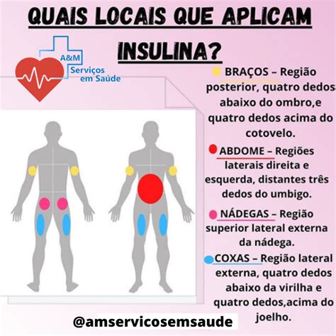 Locais De Aplica O De Insulina Enfermagem Braincp