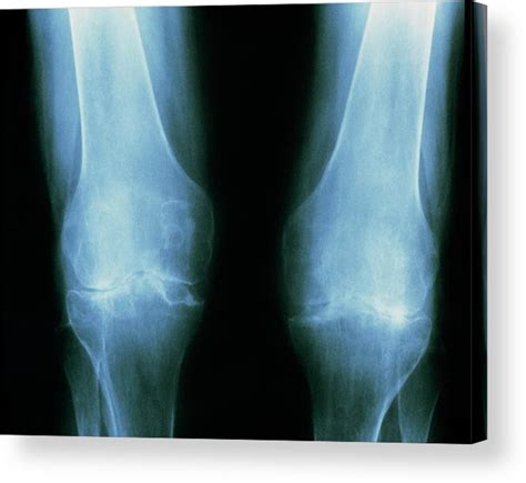 Rheumatoid Arthritis X Ray