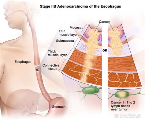 Esophageal Cancer Treatment Nci