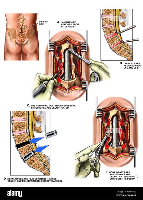 Lumbar Laminectomy Hi Res Stock Photography And Images Alamy