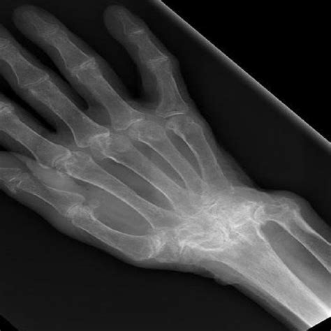 Figure5 X Ray Of A Rheumatoid Wrist With Extensive Erosions And Download Scientific Diagram