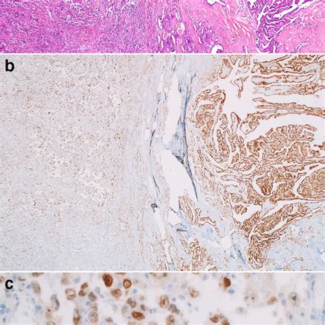 PAX8 Expression In ATC Showing Different Histologic Patterns 200 A