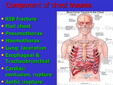 Ppt Management Of Chest Trauma Powerpoint Presentation Free Download Id 9429605