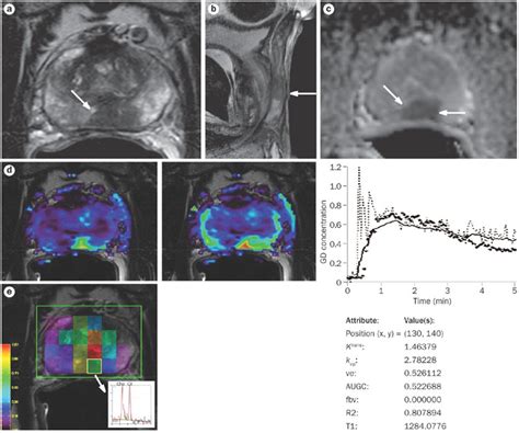 MRI Of A 53 Year Old Man With Prostate Cancer A The Axial T2 Weighted