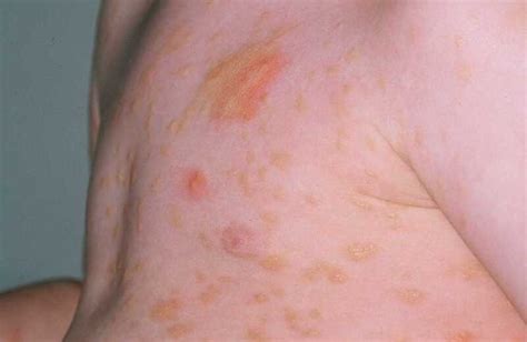 Figure Urticaria Pigmentosa Dermnet New Zealand Statpearls Ncbi