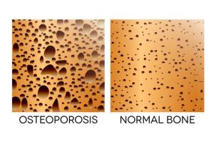 Bone Density Chart | T Score Chart - How to Understand