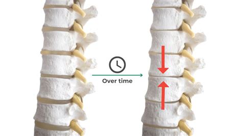 Degenerative Disc Disease Ddd On Mri And What Can Be Done