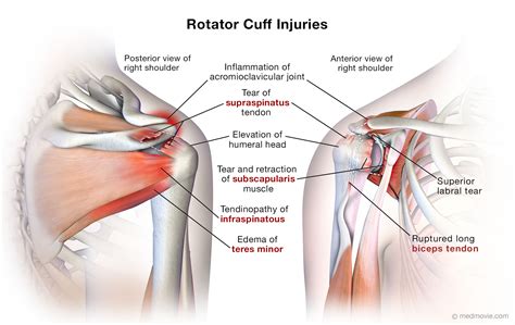 Rotator Cuff Injuries