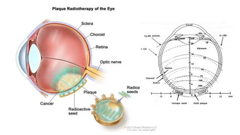 Ocular Melanoma Treatment