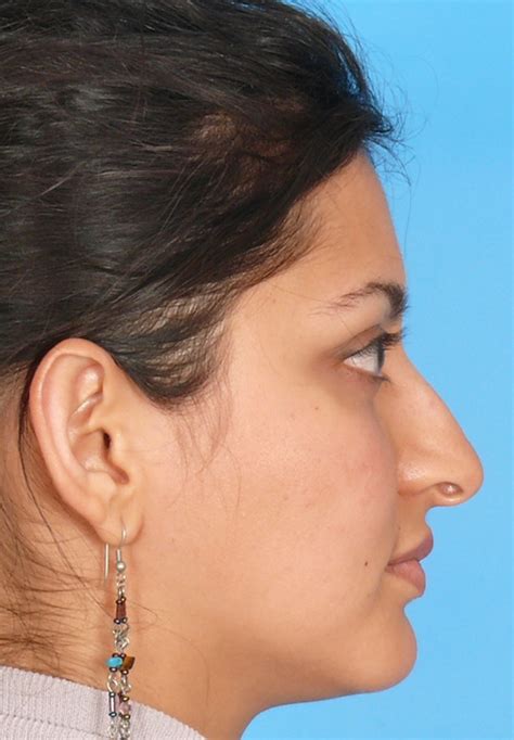 Rhinoplasty Nose Job Otoplasty Prof Dr Selçuk İnanlı