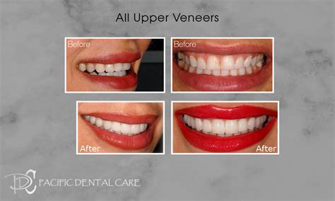 No Prep Veneers Glendale Burbank Pacific Dental Care