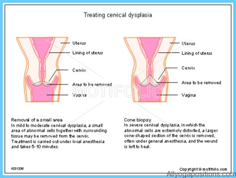 Cervical Dysplasia Treatment - All Yoga Positions