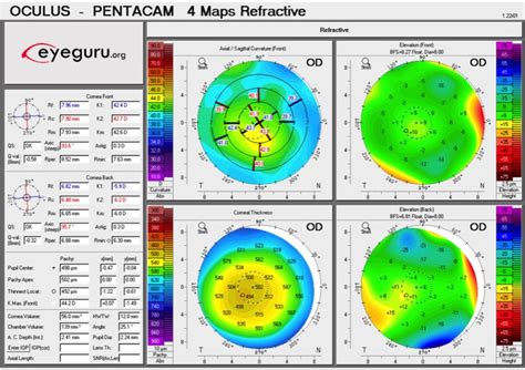 How To Interpret Corneal Topography 5 Clinical Uses Eyeguru