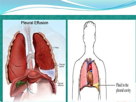 Solution Pleural Effusion Studypool