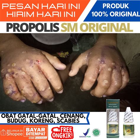 Jual Obat Oles Salep Cenang Budug Bisul Borok Luka Koreng Basah