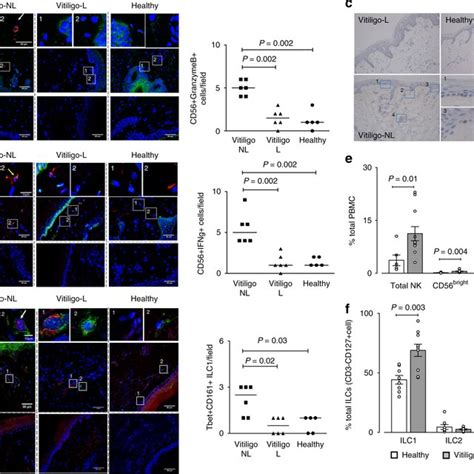 Increased Detection Of Innate Immune Cells In Non Lesional Skin Of