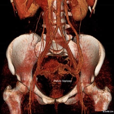 Gonadal Vein Transposition A Surgeon S Notes