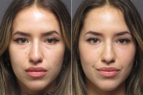 Under Eye Filler Photos Socal Aesthetic Surgery