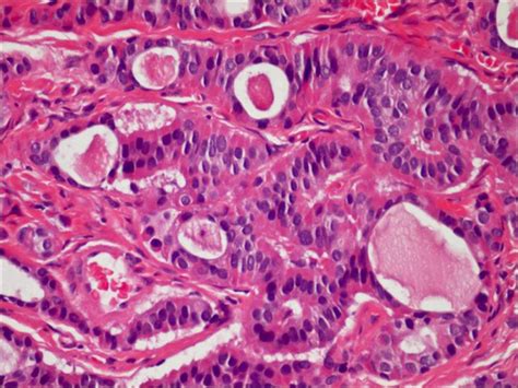 Middle ear adenoma. Tumor composed of small glands lined by a single ...