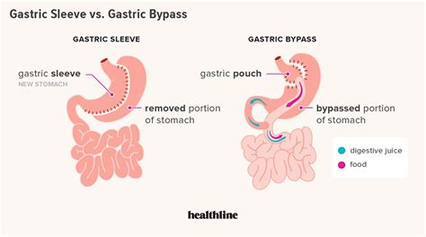 Discover Gastric Bypass Vs Sleeve Pros And Cons