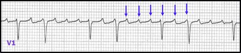 Atrial Flutter With Variable Block 37128 Hot Sex Picture