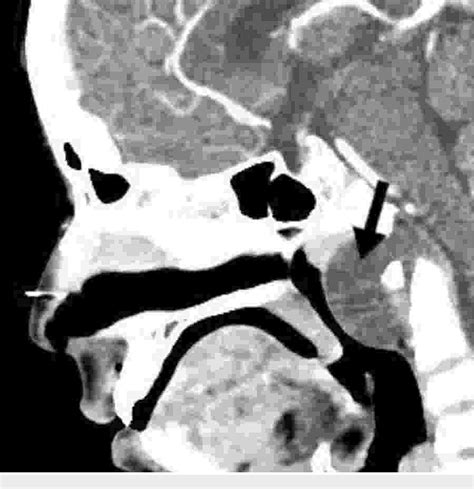 Figure From Nasopharyngeal Chordoma A Case Report Semantic Scholar