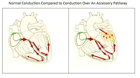 Heart Art | ECG Guru - Instructor Resources