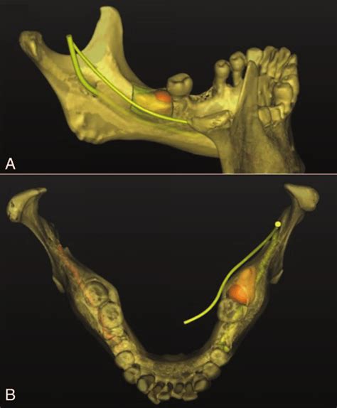 D Reconstruction Showed The Relationship Among Inferior Alveolar