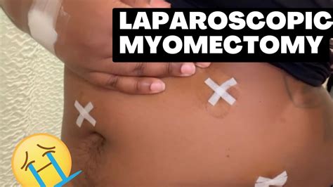 My Laparoscopic Myomectomy Surgery Youtube