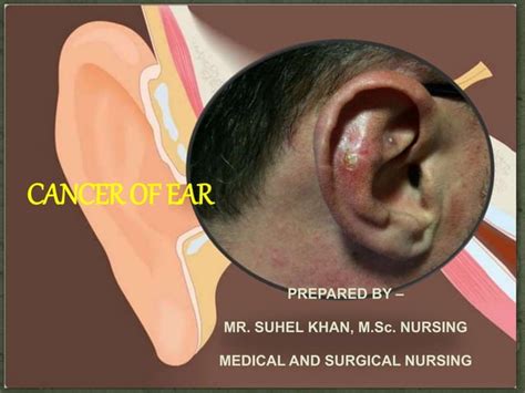 Carcinoma Of Ear Pptx