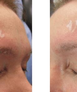 Despigmentante Para Microblading Clinica Alma Medical Chill N