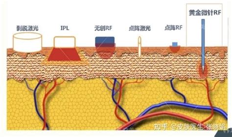 痘肌必看！痘肌可以做哪些医美？ 知乎