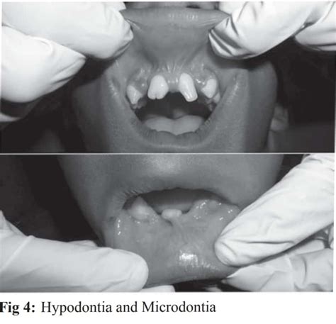 Chondroectodermal Dysplasia Ellis Van Creveld Syndrome Dentowesome