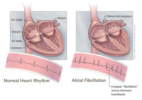 Working to improve Atrial Fibrillation treatment | Ohio State Health ...