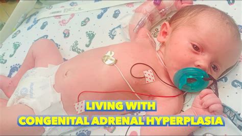 Living With Congenital Adrenal Hyperplasia 1 In Every 18000 Diagnosed Youtube