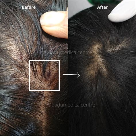 Tinea capitis scalp fungus pictures - erolasopa