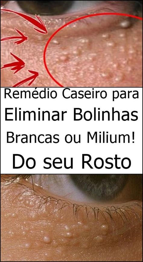 Remédio Caseiro para Eliminar Bolinhas Brancas ou Milium Facial