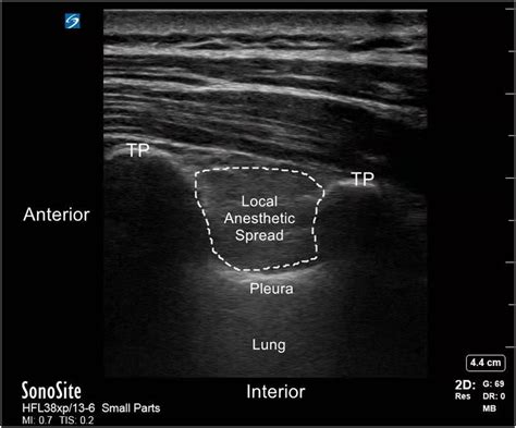 Schematic Diagram Of Ultrasound Guided Thoracic Paravertebral Block