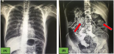 (A) Normal chest X‐ray, (B) Abdominal x‐ray showed fecal impaction in ...