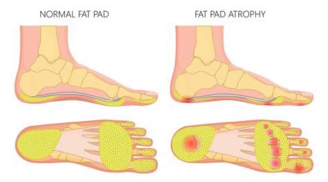 Bruised Heel All The Answers From A Foot Specialist