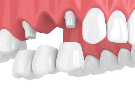 All About Removable Dental Bridges Dentist In New Orleans LA