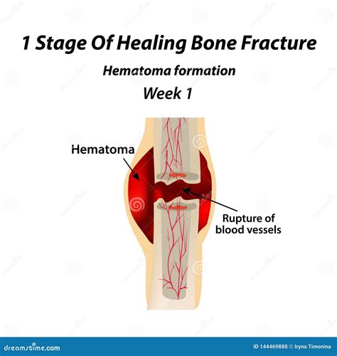 Stage Of Healing Bone Fracture Formation Of Callus The Bone