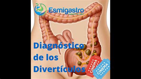 Diverticulos Esmigastro