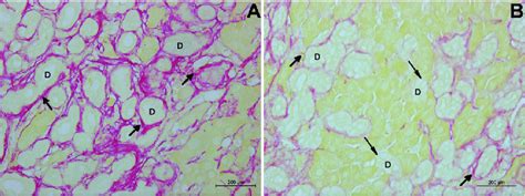 Representative Microphotographs Of Liver With Biliary Fibrosis In The