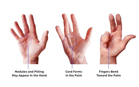 What Is Dupuytrens Contracture And How Can It Be Treated B T Ch Xanh